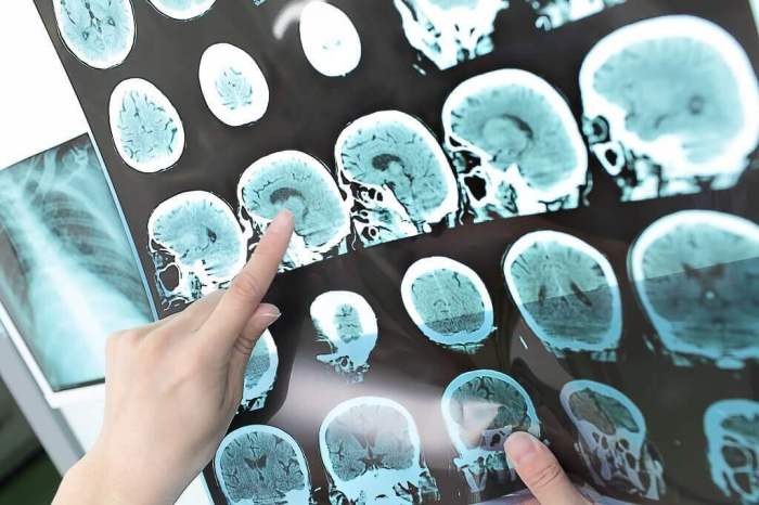 Bertahan dari Tumor Otak dan Kembali Aktif Kuliah