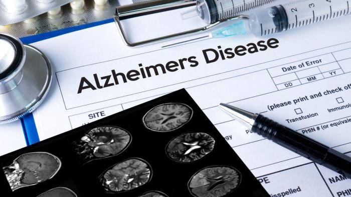 Tes Logika Bisa Bantu Deteksi Gejala Dini Alzheimer