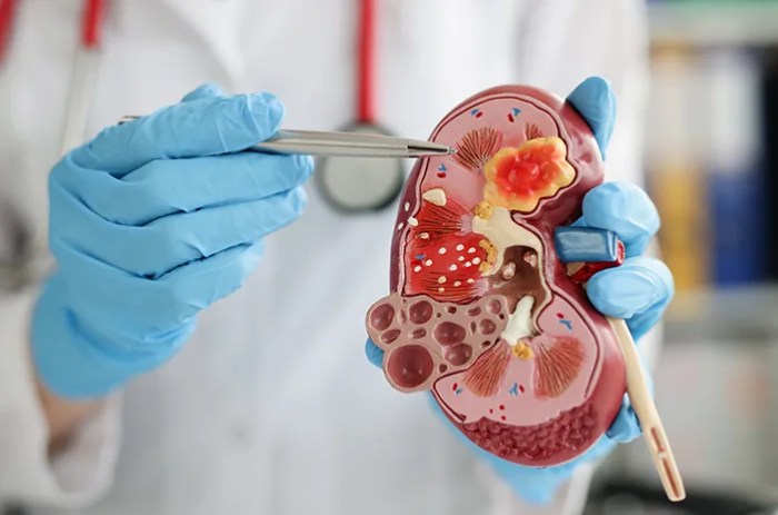 Dokter Jelaskan Hubungan Erat Antara Hipertensi dan Gagal Ginjal